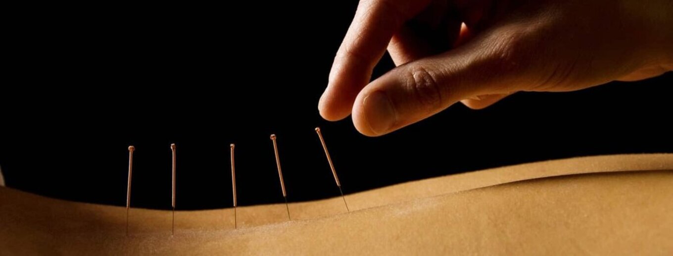 Sesión de acupuntura: agujas finas aplicadas sobre la espalda de un paciente